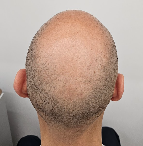 calvitie homme retrait ligne frontale homme perte de cheveux homme chute cheveux héréditaire traitement chute de cheveux homme